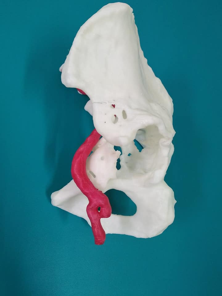 Двобічний коксартроз, стан після ТЕП кульшових суглобів 3D